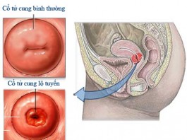 Nguyên nhân lộ tuyến cổ tử cung