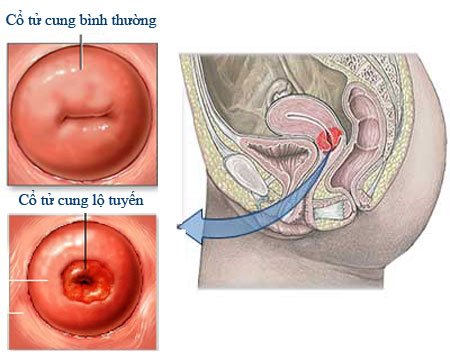 Nguyên nhân lộ tuyến cổ tử cung