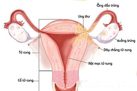 lộ tuyến cổ tử cung là gì